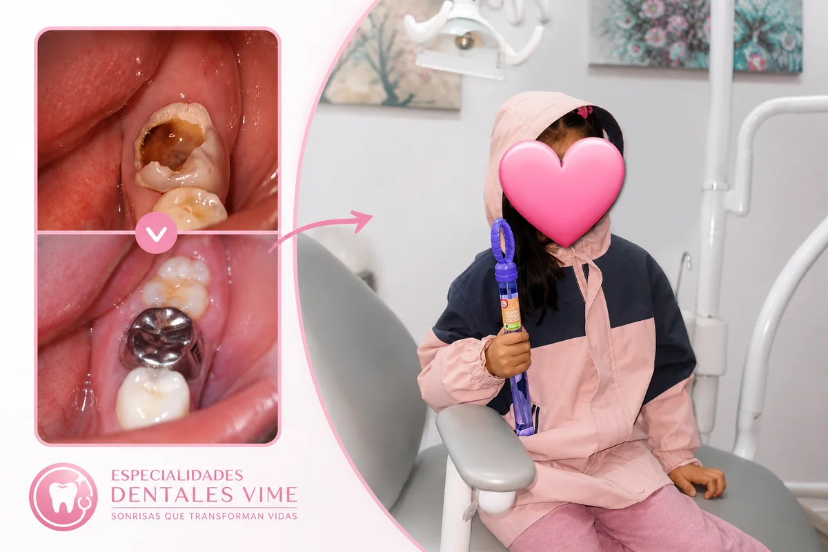 Caso de odontopediatría: rehabilitación de molar en niño, antes y después
