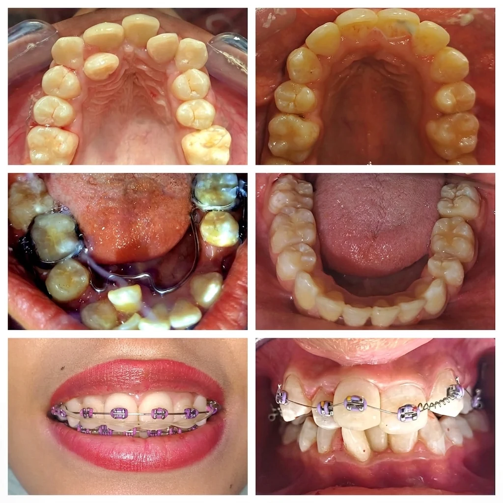 Caso real de ortodoncia adolescente: proceso completo con brackets