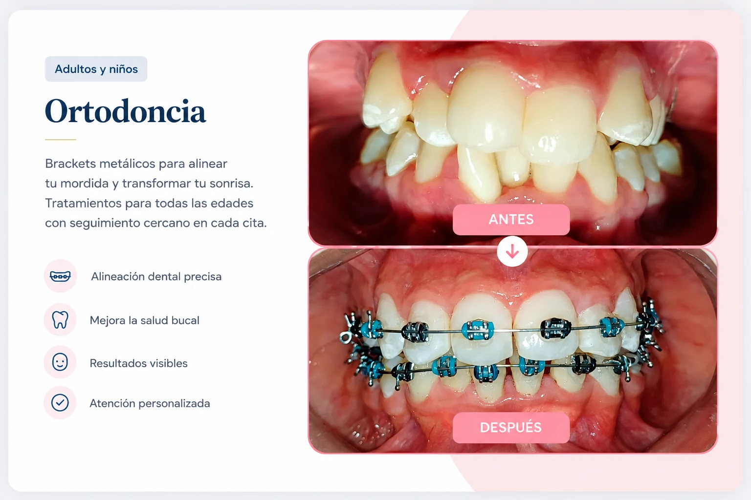 Caso de éxito de ortodoncia: antes y después con brackets metálicos